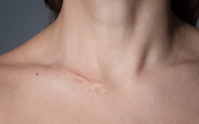Scars and Dermal Needling